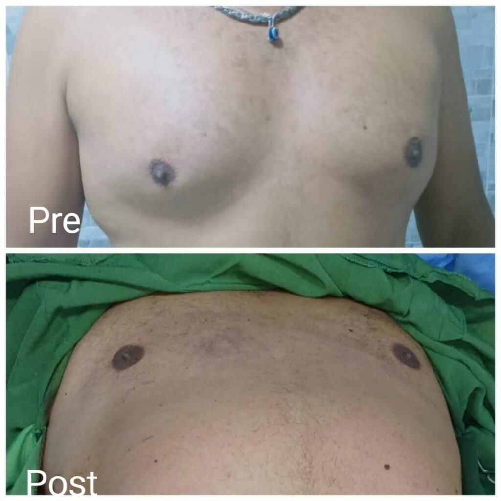Gynecomastia surgery for men